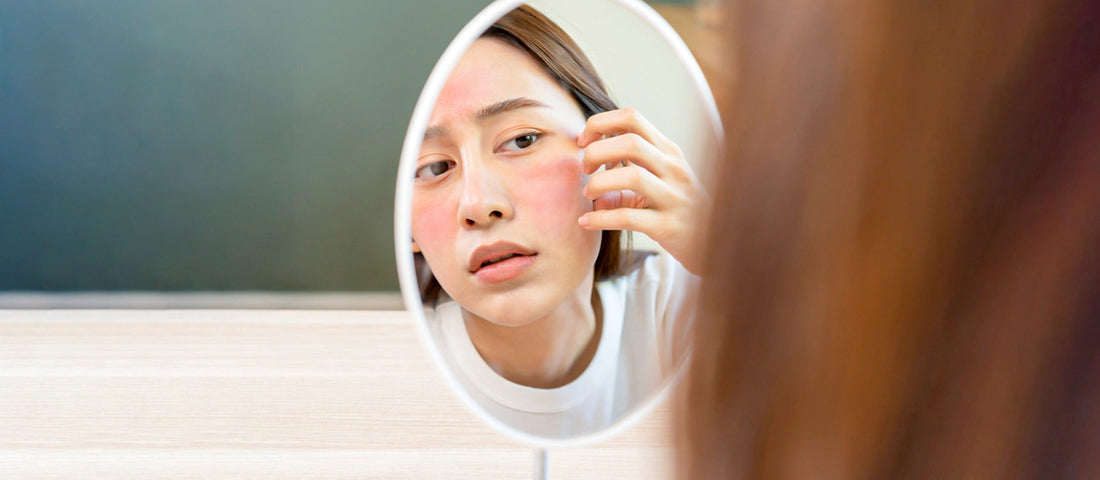 Which Herbal Treatments Help Most with Redness, Rashes, and Reactions?